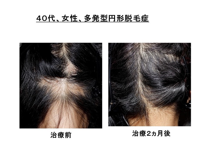 汎発性脱毛　病院